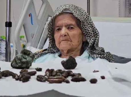Karın ağrısı sandı, meğer taşmış! Hurma ile zeytin tek suçlusu: ‘Kimse yutmasın’