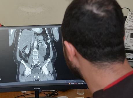 Karın şişliği için hastaneye gitti, hayatını şokunu yaşadı! ‘Neredeyse tamamını kaplamıştı’