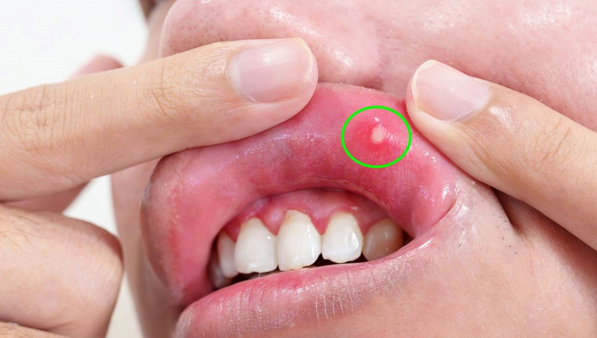 5 belirgin B vitamini eksikliği belirtisi: Vücut için hayati önemi var