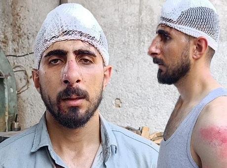 50 kilometre hız dayağı! Burnu kırıldı, başına 8 dikiş atıldı