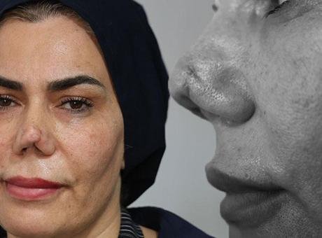 Burnu kırıldı, 4 operasyon sonrası hayatı kabusa döndü: Resmen hayattan koptum