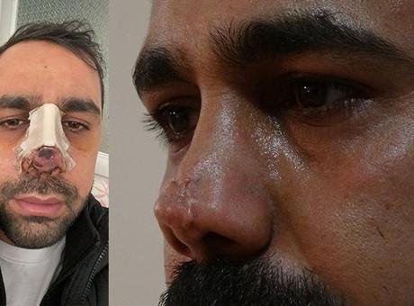 Burun ameliyatı sonrası hayatı kabusa döndü! 40 bin avroluk tedavi çıktı