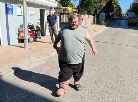 4 yıldır fil hastalığıyla mücadele ediyor! Yürümek için 82 kilo vermesi gerekiyor