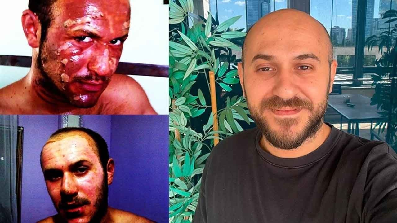 Yüzü yanan genç kantaron yağıyla iyileştiğini iddia etti