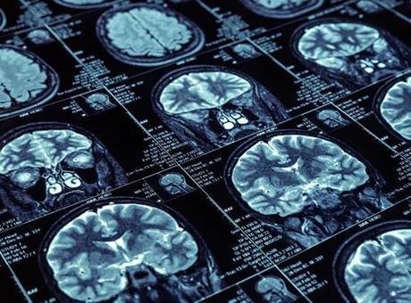 45 yaş üstü dikkat! Ezber bozan araştırma: ‘3 basit alışkanlık demansı 13 yıl geciktirebilir’