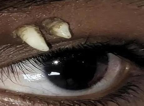 Doktorlar şaşkına döndü! Gözünden diş çıktı: ‘İlk ve tek vaka’